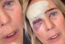 Felipa Garnel operada a cancro de pele: "Faço este vídeo de propósito para vos impressionar"