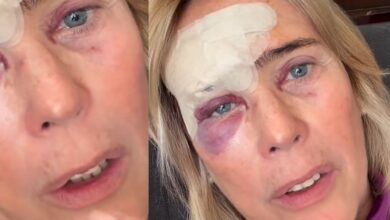 Felipa Garnel operada a cancro de pele: "Faço este vídeo de propósito para vos impressionar"