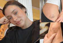 Daniela Melchior exibe hematomas e assinala fim das gravações de «A Night in Porto»