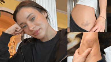 Daniela Melchior exibe hematomas e assinala fim das gravações de «A Night in Porto»