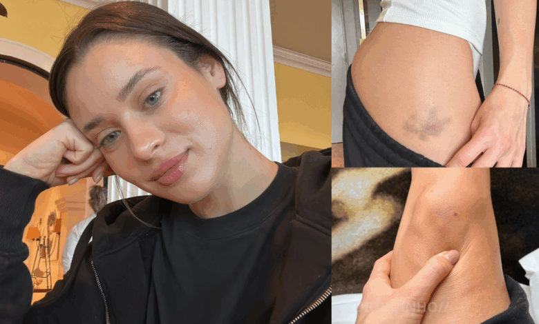 Daniela Melchior exibe hematomas e assinala fim das gravações de «A Night in Porto»