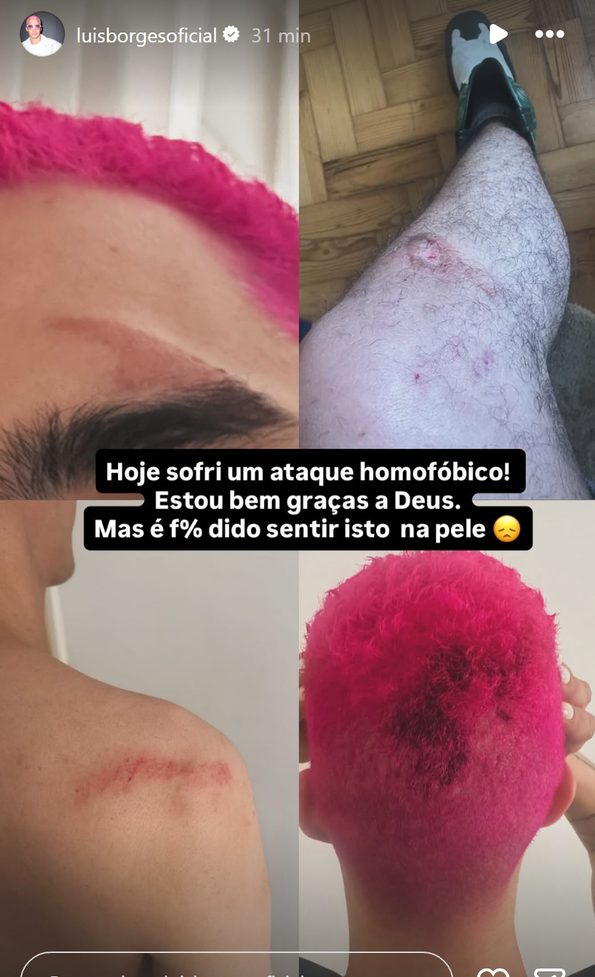 Luís Borges agredido exibe ferimentos no rosto e no corpo: "Hoje sofri um ataque homofóbico"